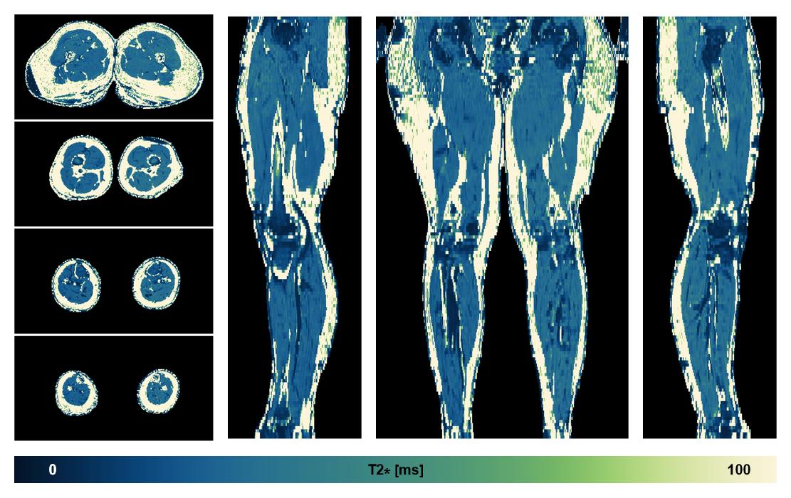The T2 star relaxation time of the lower extremity obtained from the dixon reconstruction for muscle water fat quantification.